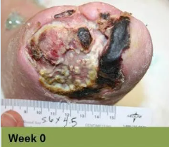 Heel ulcer, open wound. Brown skin with a deep, red sore. Week 0.