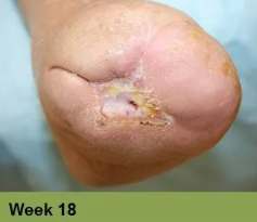 Foot with a deep, open wound on the heel, surrounded by discolored skin.