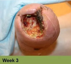 Foot with a large, open wound, wrapped in clear dressing; labeled 