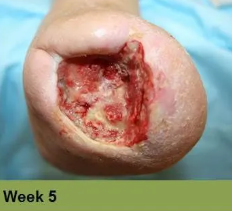 Heel with severely damaged skin, possibly a pressure ulcer, displaying dark discoloration. 