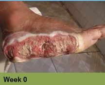 Heel ulcer, open wound. Brown skin with a deep, red sore. Week 0.