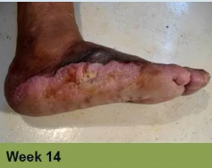 Foot with a large, open wound, wrapped in clear dressing; labeled 
