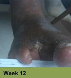 Heel with a large, open sore, showing signs of tissue damage. The surrounding skin is discolored.