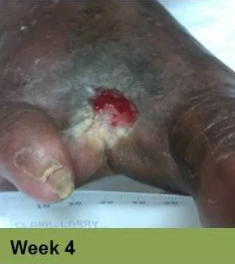 A close-up of a foot with a deep, open wound. Red, raw tissue visible. “Week 9” is in a green bar below.