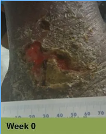 Close-up of a wound on skin, with ruler for scale.  Wound is open, bloody, surrounded by inflamed, discolored skin.