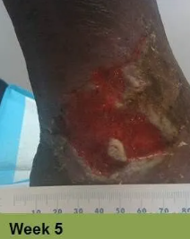 Foot with a deep, open wound and a ruler for scale. The wound has exposed tissue with a yellow edge.