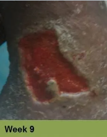 Hand with a healing wound, ruler, and bandage; week 7.