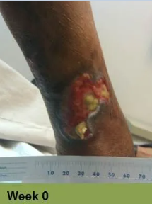 Foot with deep, open ulcer. Skin is swollen and discolored.  The ulcer is reddish with exposed tissue.