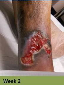 Foot with a deep, open wound, swollen toes, and discoloration.
