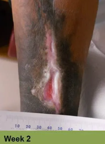Foot with an open wound, Week 2. Skin is torn, revealing red flesh.