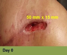 Foot with open wound on big toe. The wound has red tissue and a yellow-white border.