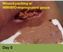 Foot with an open sore on the toe, showing redness and potential tissue damage; the image has a week 5 caption.