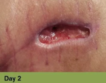 Foot with a deep, red ulcer on the ball, with slight discoloration; week 2 of treatment.