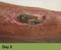 Foot with deep, open ulcer. Skin is swollen and discolored.  The ulcer is reddish with exposed tissue.