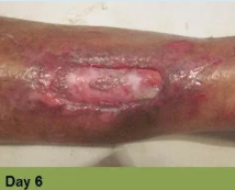 Foot with a deep, open wound, swollen toes, and discoloration.