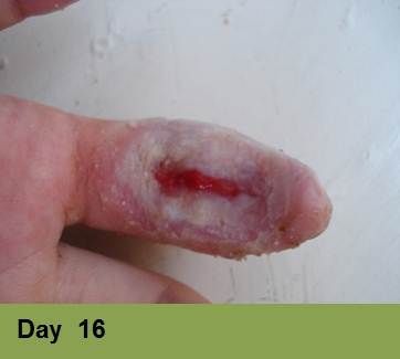 Heel with a large, open sore, showing signs of tissue damage. The surrounding skin is discolored.