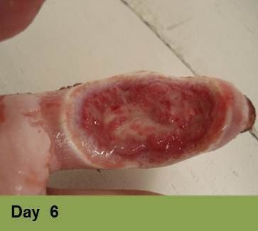 Foot with open ulcer, red tissue, yellow and dry skin, stage 15.