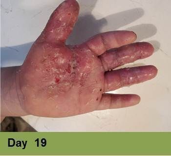 Heel with severely damaged skin, possibly a pressure ulcer, displaying dark discoloration. 