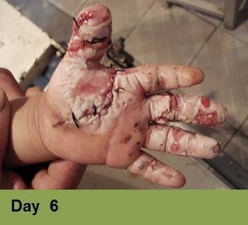 Foot with a large, open wound, wrapped in clear dressing; labeled 