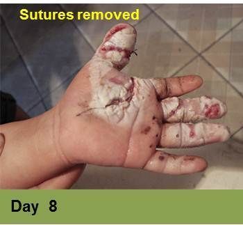 Foot with a deep, open wound on the heel, surrounded by discolored skin.