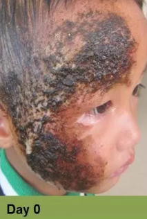 Foot with deep, open ulcer. Skin is swollen and discolored.  The ulcer is reddish with exposed tissue.