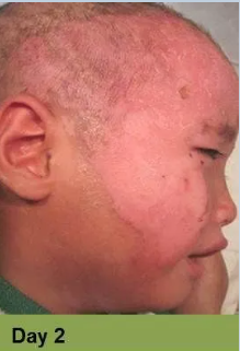 Wound on leg, Week 4.  The open sore is reddish-brown with surrounding pale skin.