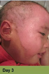 Foot with a deep, open wound, swollen toes, and discoloration.