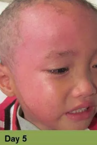 Foot with swollen toes, discolored nails, and signs of skin breakdown; labeled 