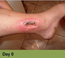 Foot with open wound on big toe. The wound has red tissue and a yellow-white border.