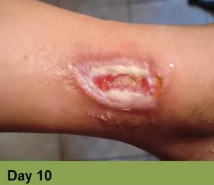 Foot with an open sore on the toe, showing redness and potential tissue damage; the image has a week 5 caption.