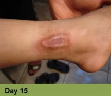 Foot with healing wounds, possibly diabetic, at week 6. Light skin, indoors setting.