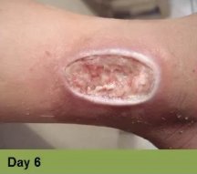 Foot with a deep, red ulcer on the ball, with slight discoloration; week 2 of treatment.