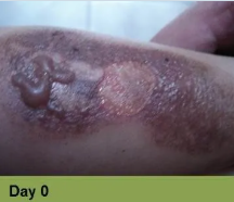 Foot with open wound, red tissue, and exposed bone; labeled 