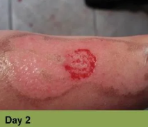 Foot with an open wound, Week 2. Skin is torn, revealing red flesh.