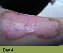 Foot with healed wound, likely diabetic ulcer, at 8-week mark. Skin is yellowed with scarring.