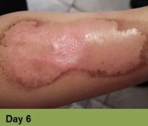 Foot with a wound on the toe, appears to be healing. Text reads 