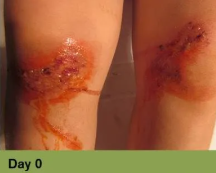 Close-up of a wound on skin, with ruler for scale.  Wound is open, bloody, surrounded by inflamed, discolored skin.