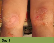 Foot with a deep, open wound and a ruler for scale. The wound has exposed tissue with a yellow edge.