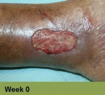 Close-up of a wound on skin, with ruler for scale.  Wound is open, bloody, surrounded by inflamed, discolored skin.