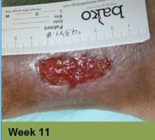 Hand with a healing wound, ruler, and bandage; week 7.