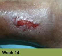 Close-up of a leg with a small, circular wound, white and pink, surrounded by dry, reddish skin.