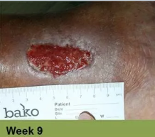 Foot with a deep, open wound and a ruler for scale. The wound has exposed tissue with a yellow edge.