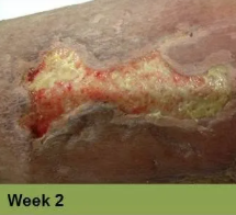 Foot with an open wound, Week 2. Skin is torn, revealing red flesh.