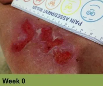 Heel ulcer, open wound. Brown skin with a deep, red sore. Week 0.