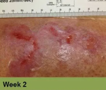 Foot with a large, open wound, wrapped in clear dressing; labeled 