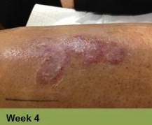 Foot with a deep, open wound on the heel, surrounded by discolored skin.