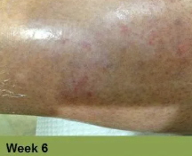 Heel with severely damaged skin, possibly a pressure ulcer, displaying dark discoloration. 