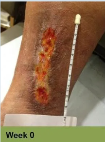 Foot with a large, open wound; measured as 120 mm x 70 mm. The wound is red and brown, and healing progress is at 