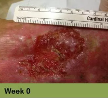 Heel ulcer, open wound. Brown skin with a deep, red sore. Week 0.