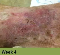 Heel with severely damaged skin, possibly a pressure ulcer, displaying dark discoloration. 